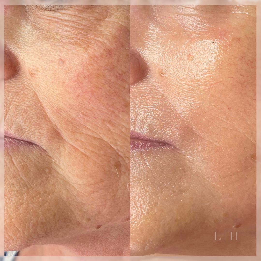 Personalised medical-grade skincare being prepared by a skin specialist for at-home use at Liberty Hall Skin Clinic. 