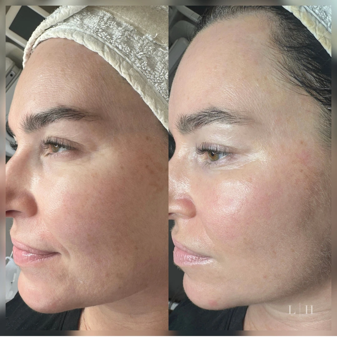 Liberty Hall. Red Carpet Facial. Instant Glow and hydration