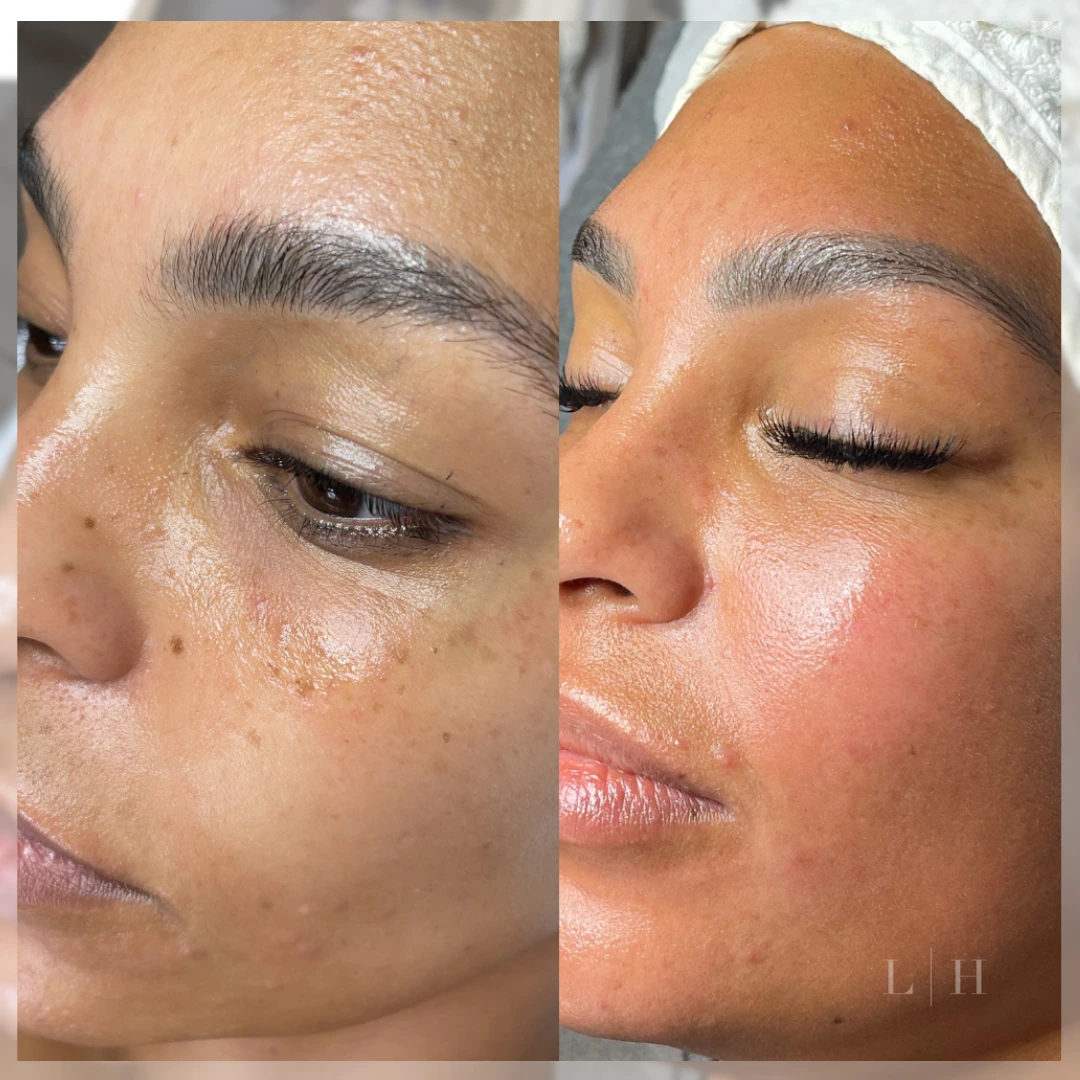 age reversal face lift facial liberty hall